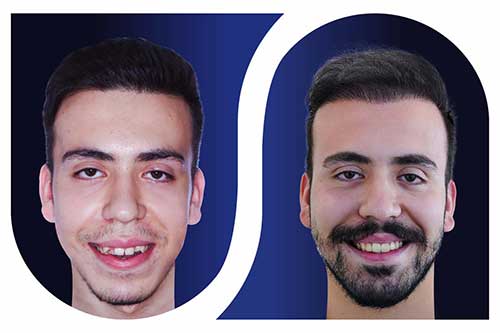 عوارض ارتودنسی در کودکان و بزرگسالان 5 عوارض ارتودنسی در سنین بالا