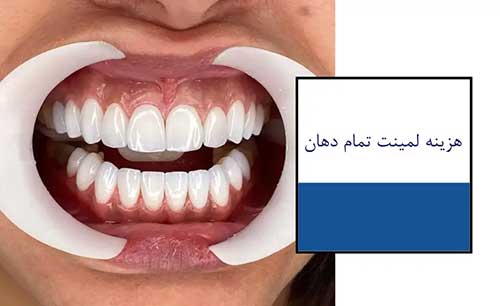 قیمت لمینت تمام دندان ها در طرح لبخند