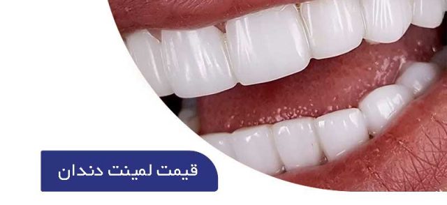 قیمت لمینت دندان | هزینه لمینت دندان
