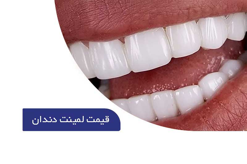 قیمت لمینت دندان | هزینه لمینت دندان