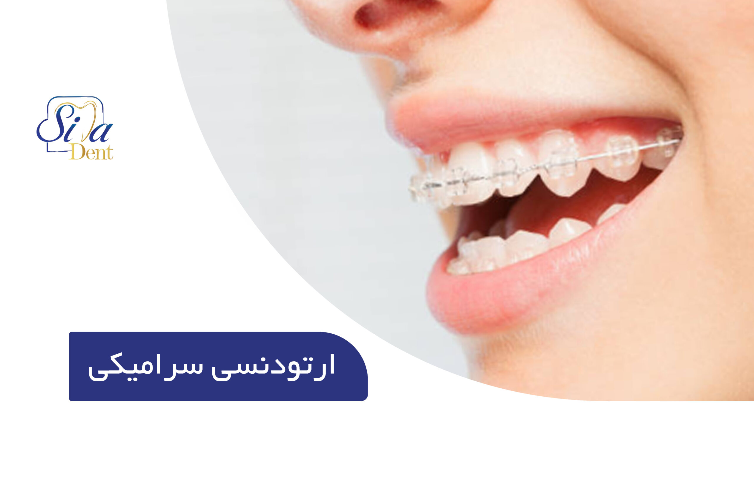ارتودنسی سرامیکی؛ مزایا، معایب و کاندیدای مناسب آن 1 ارتودنسی سرامیکی