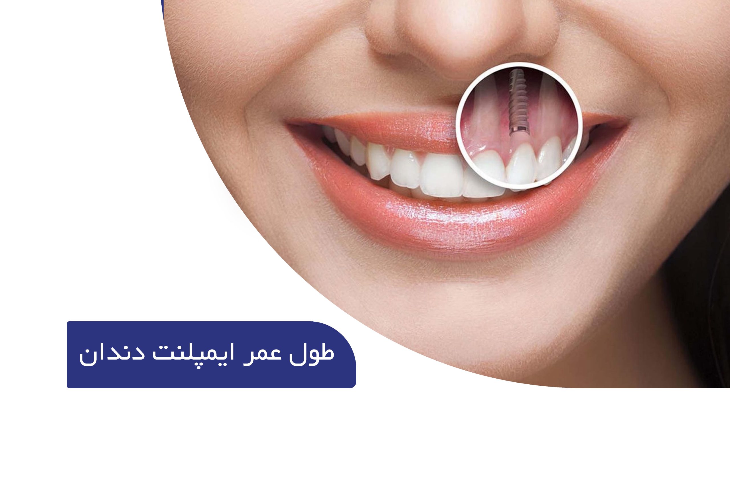 طول عمر مفید ایمپلنت دندان چقدر است؟ 1 طول عمر ایمپلنت دندان