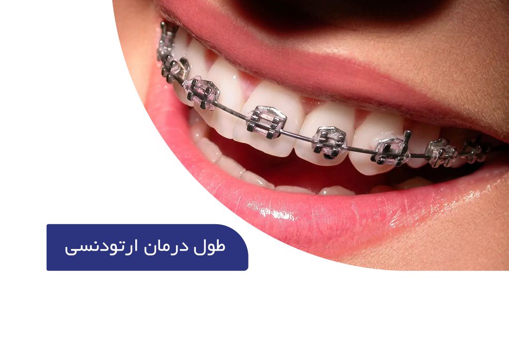 مدت زمان ارتودنسی دندان 12 مدت زمان ارتودنسی دندان