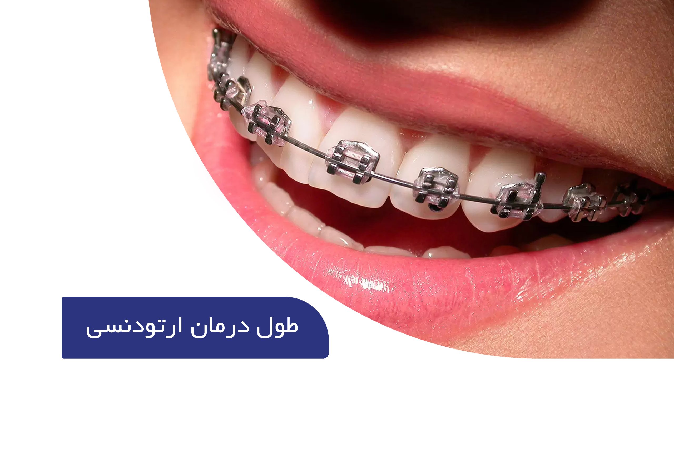 مدت زمان ارتودنسی دندان 1 مدت زمان ارتودنسی دندان