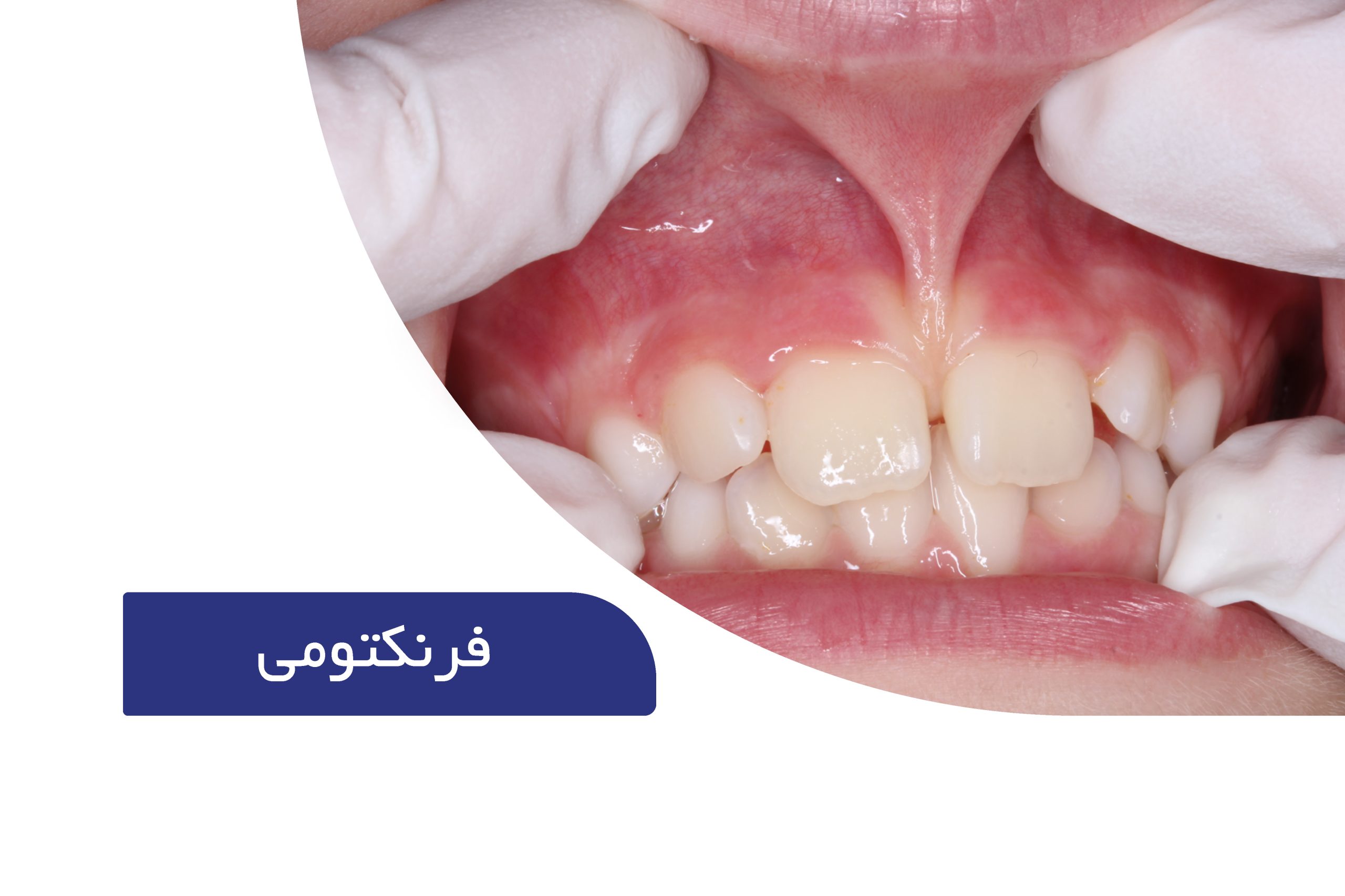 فرنکتومی (جراحی حذف فرنوم با لیزر) 1 فرنکتومی
