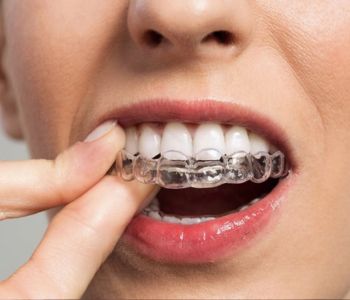 ارتودنسی نامرئی (مزایا و معایب الاینر شفاف) 9 مزایای ارتودنسی نامرئی