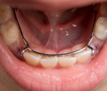 هزینه دندانپزشکی فضانگهدار برای کودکان
