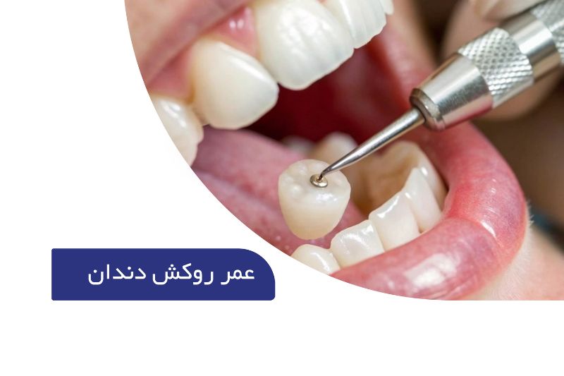 طول عمر مفید روکش دندان 1 عمر روکش دندان