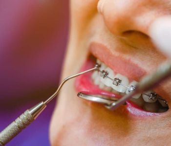 فرق ارتودنسی با لمینت از نظر هدف درمان