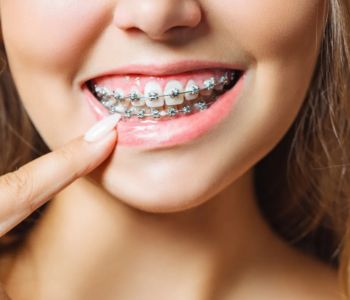 ارتودنسی بهتر است یا کامپوزیت