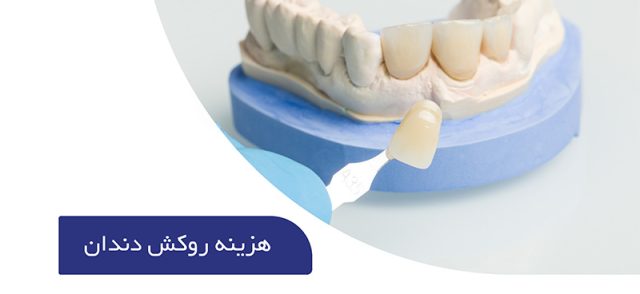 هزینه روکش دندان چقدر است؟