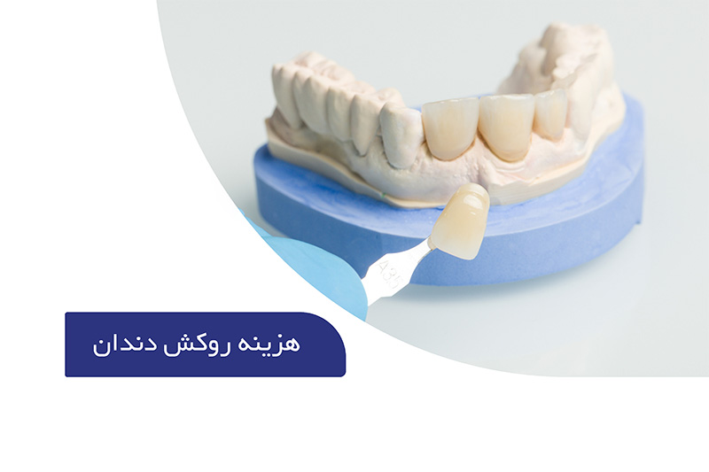 قیمت روکش دندان (هزینه روکش دندان 1405) 1 هزینه روکش دندان چقدر است؟