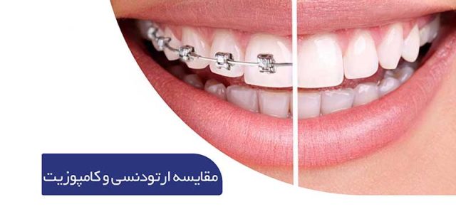 تفاوت ارتودنسی با کامپوزیت