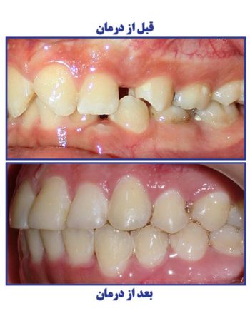 سن مناسب برای اولین معاینه ارتودنسی