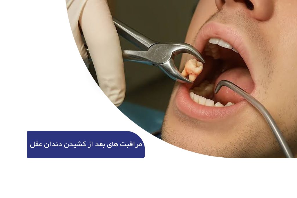 مراقبت های بعد از کشیدن دندان عقل
