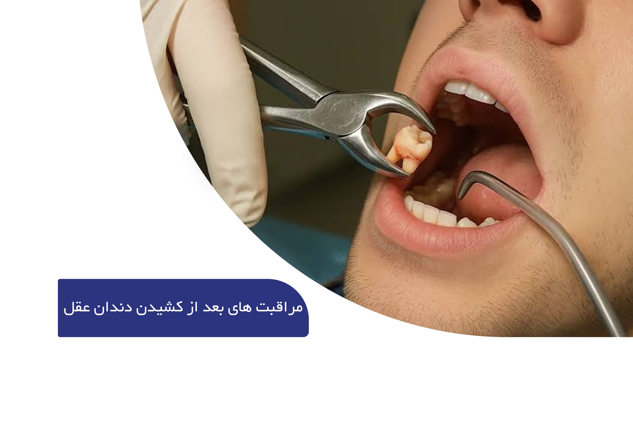 مراقبت های بعد از کشیدن دندان عقل
