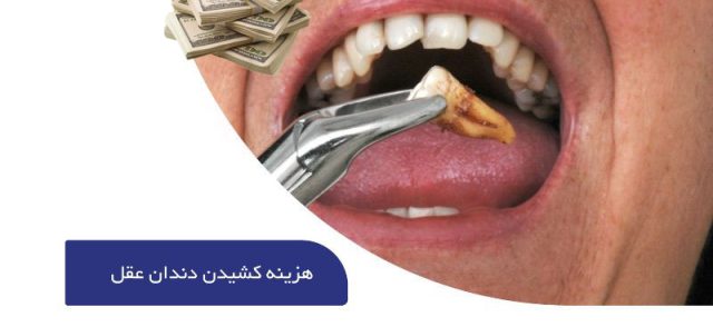 هزینه کشیدن دندان عقل | قیمت کشیدن دندان عقل