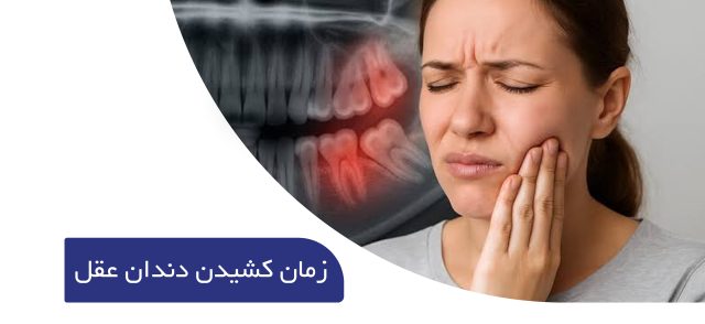 زمان کشیدن دندان های عقل