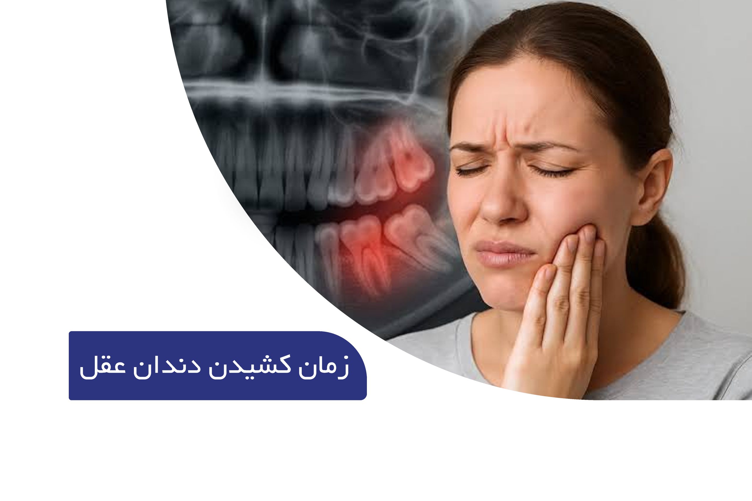 زمان کشیدن دندان های عقل