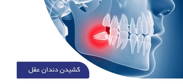 کشیدن دندان عقل