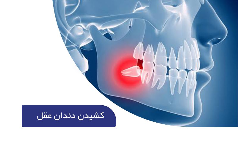 کشیدن دندان عقل
