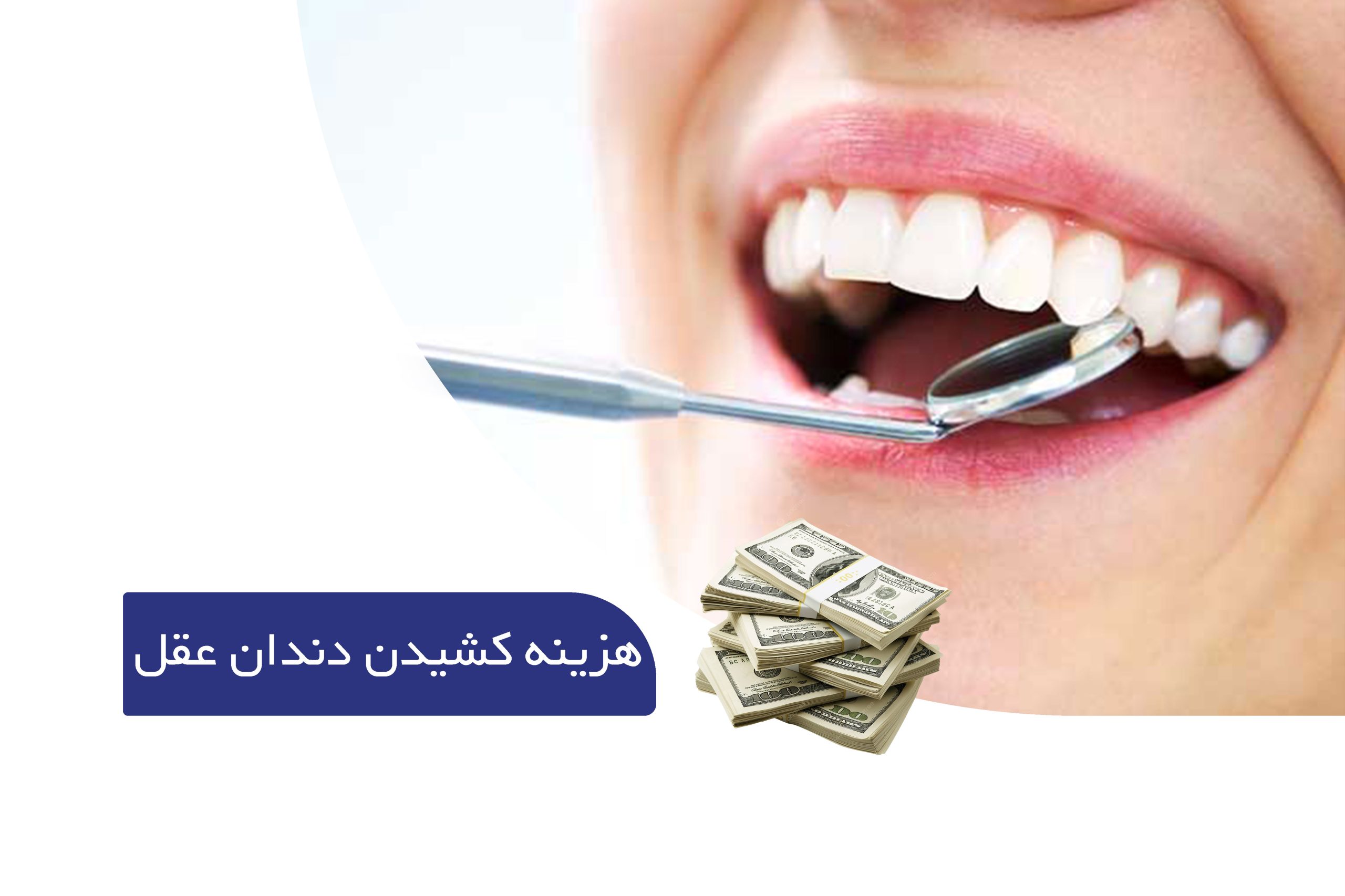 هزینه کشیدن دندان عقل | قیمت کشیدن دندان عقل