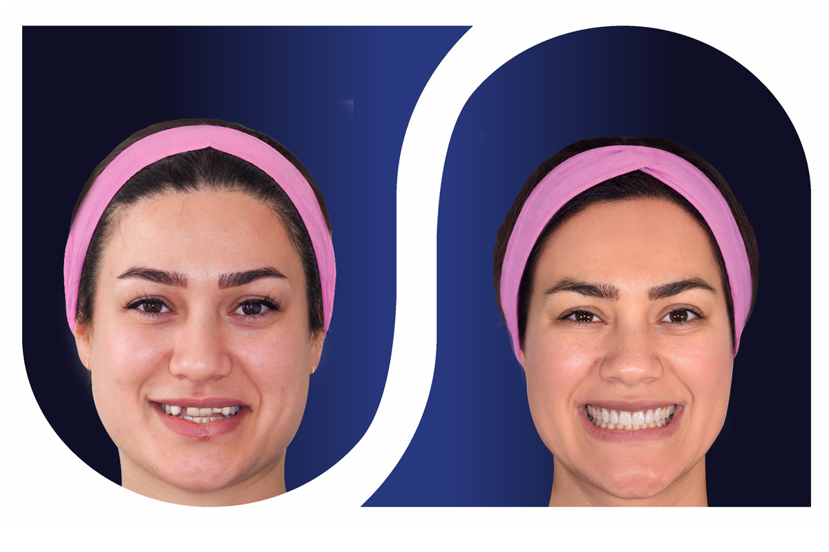 ارتودنسی، جراحی فک و ایمپلنت
