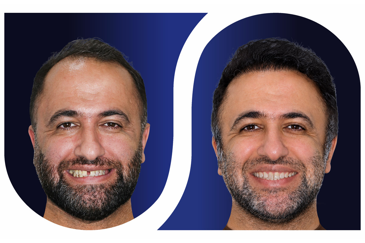 ارتودنسی نامرئی