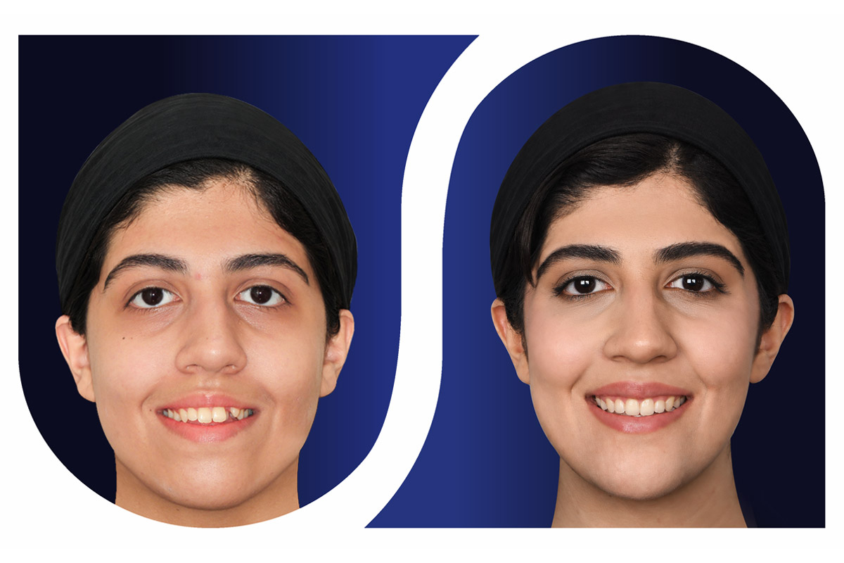 ارتودنسی بدون جراحی فک