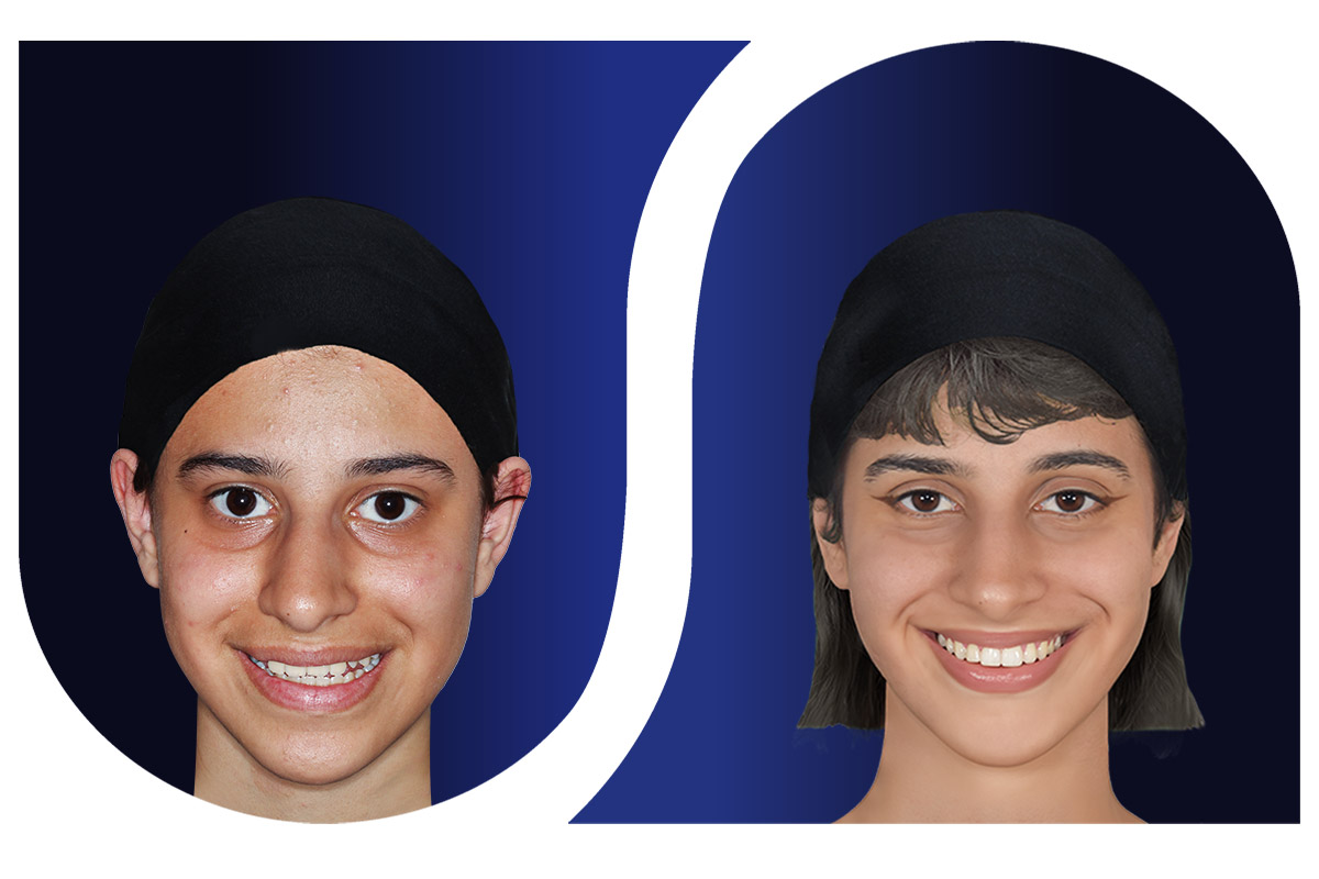  ارتودنسی کاموفلاژ (جبرانی)