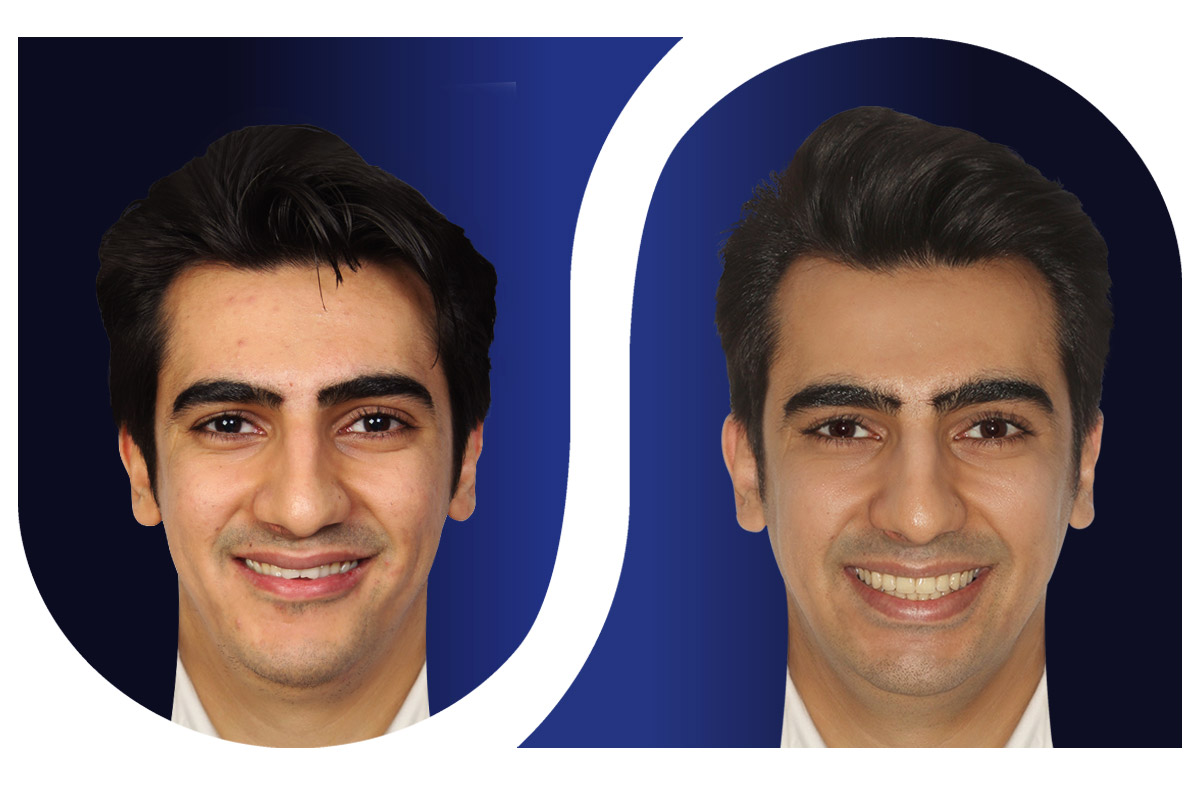 ارتودنسی کراس بایت